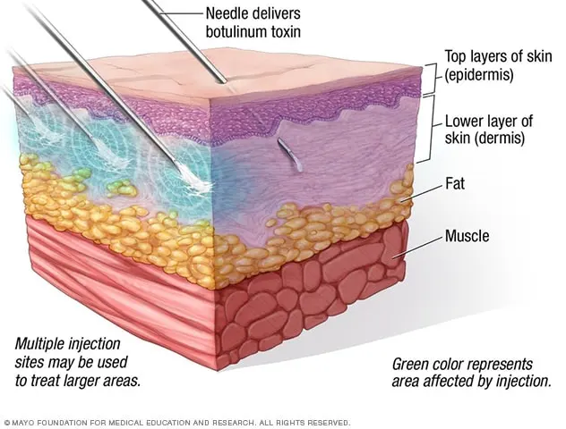 Intradermal Botox injection Enlarge image